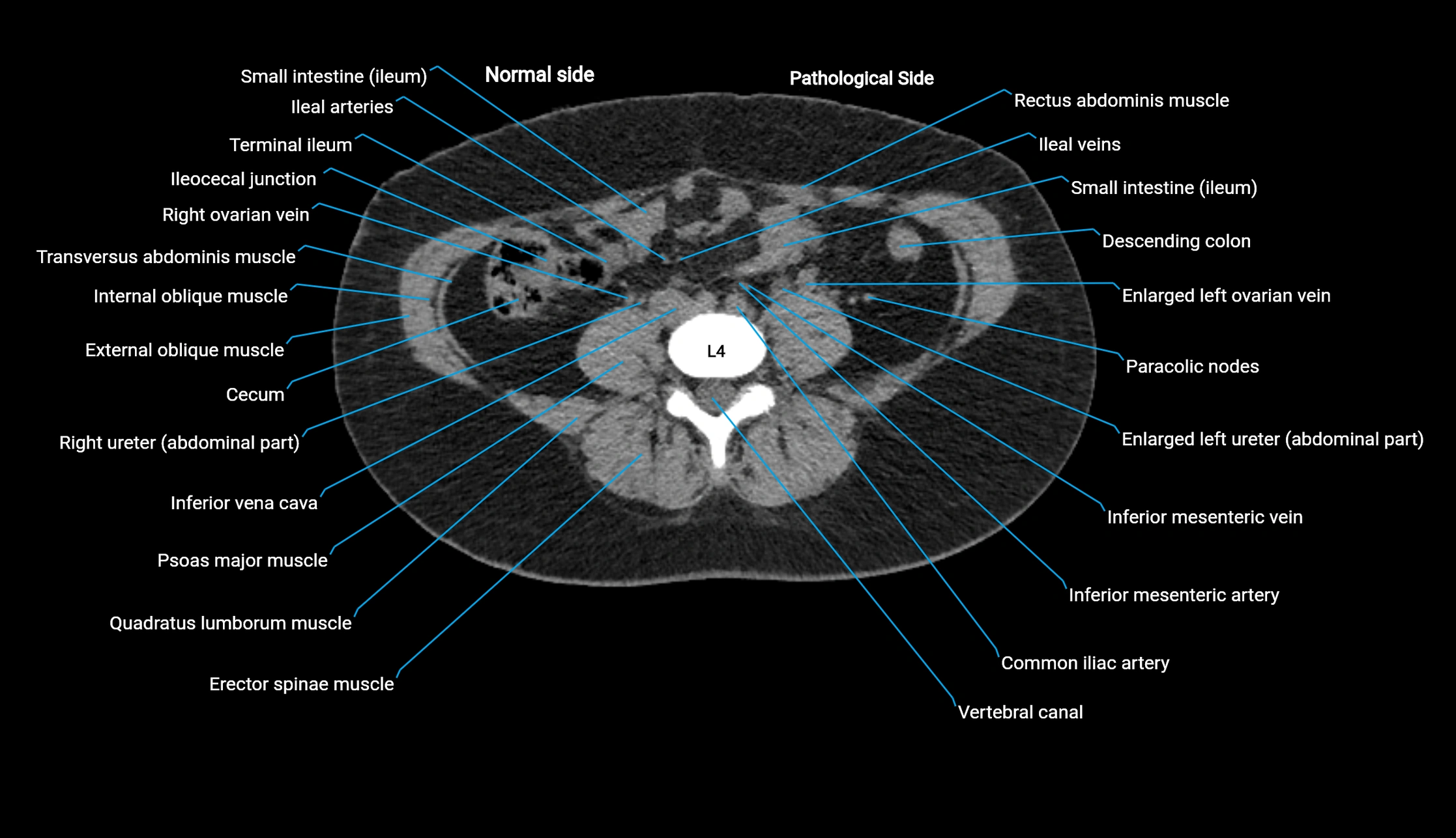 CT KUB axial cross sectional anatomy  radiology image -img-00201-00092.webp